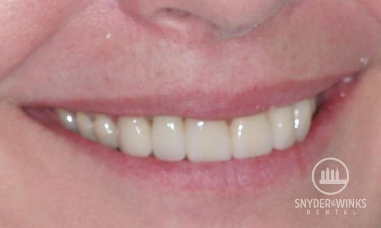 Implants-After-Image