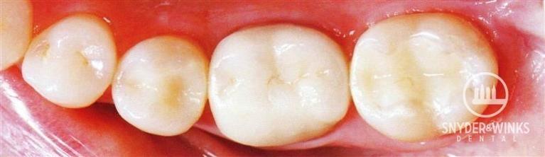 Metal-Fillings-After-Image