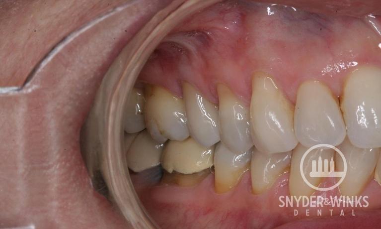 Porcelain-Crowns-After-Image
