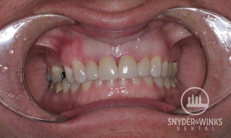 Porcelain-Crowns-After-Image