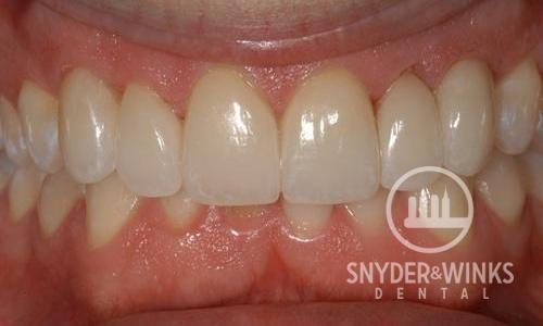 Porcelain-Veneers-After-Image