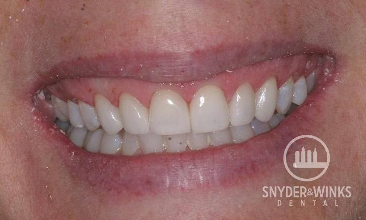 Porcelain-Veneers-After-Image