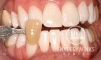 Teeth-Whitening-After-Image