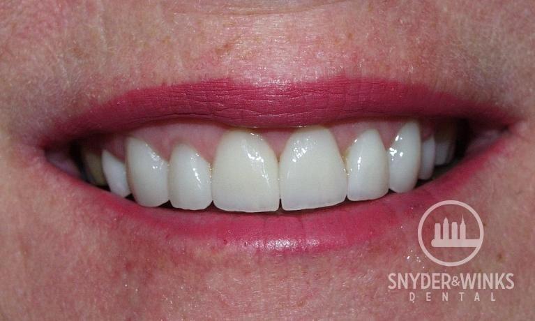 Veneers-and-Crowns-After-Image
