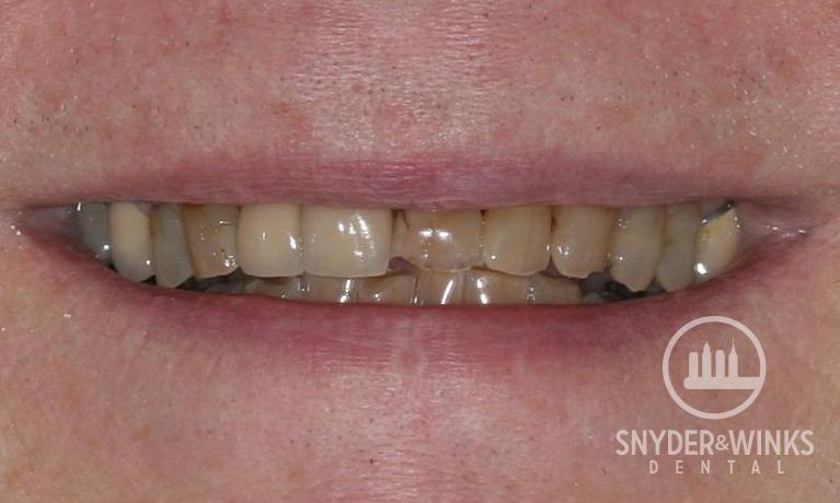 Bonding-and-Crowns-Before-Image