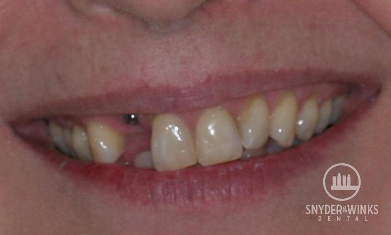 Implants-Before-Image