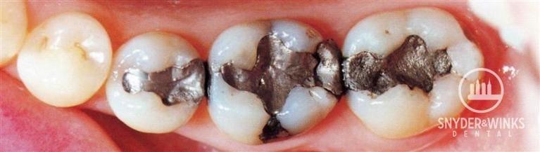 Metal-Fillings-Before-Image
