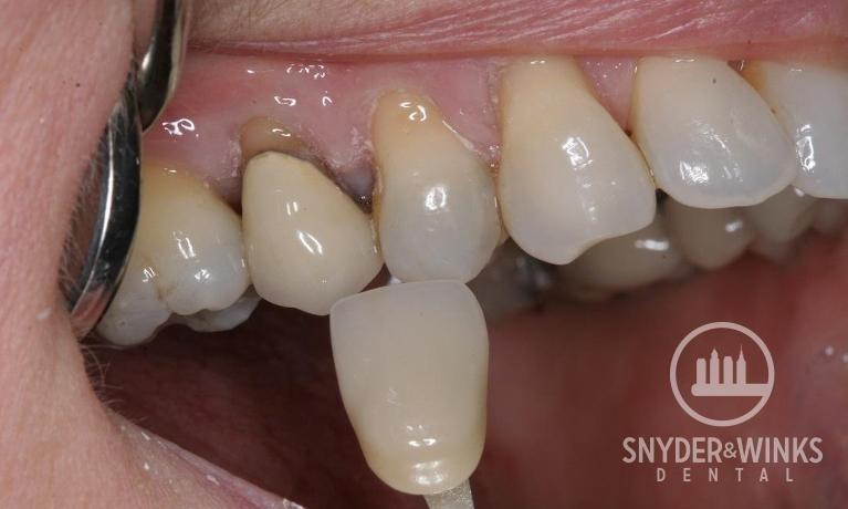 Porcelain-Crowns-Before-Image