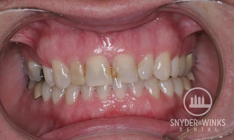 Porcelain-Crowns-Before-Image