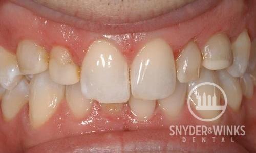 Porcelain-Veneers-Before-Image