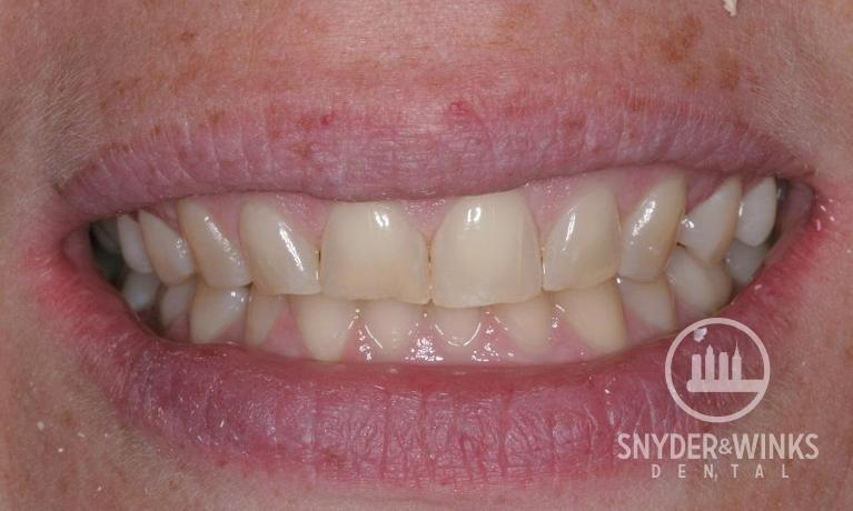 Porcelain-Veneers-Before-Image