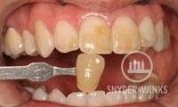 Teeth-Whitening-Before-Image