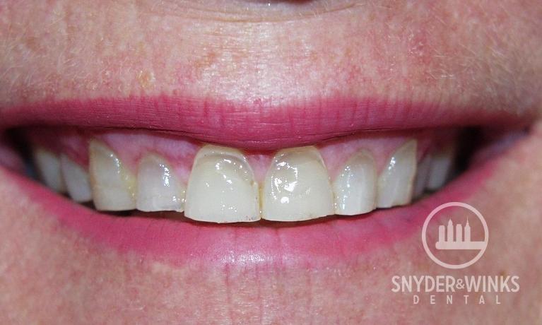 Veneers-and-Crowns-Before-Image